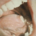 Syphilis Chancre (Tongue)