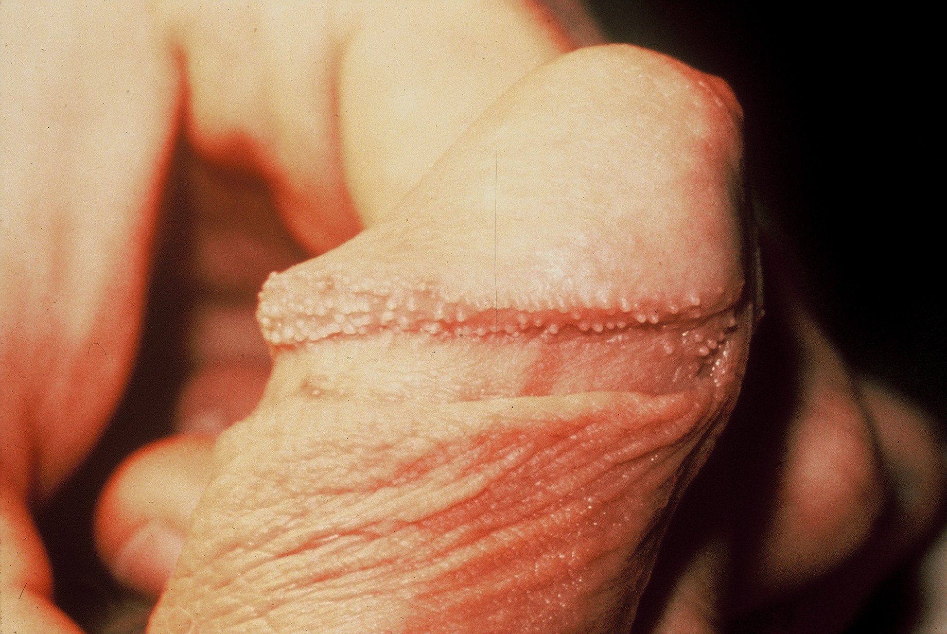 On papules shaft penile pearly Common cause