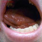 Herpes (Oral)