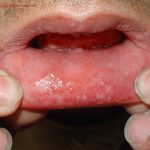 Herpes (Oral)
