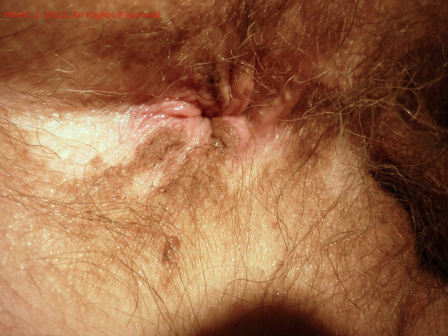 Vitiligo of the penis