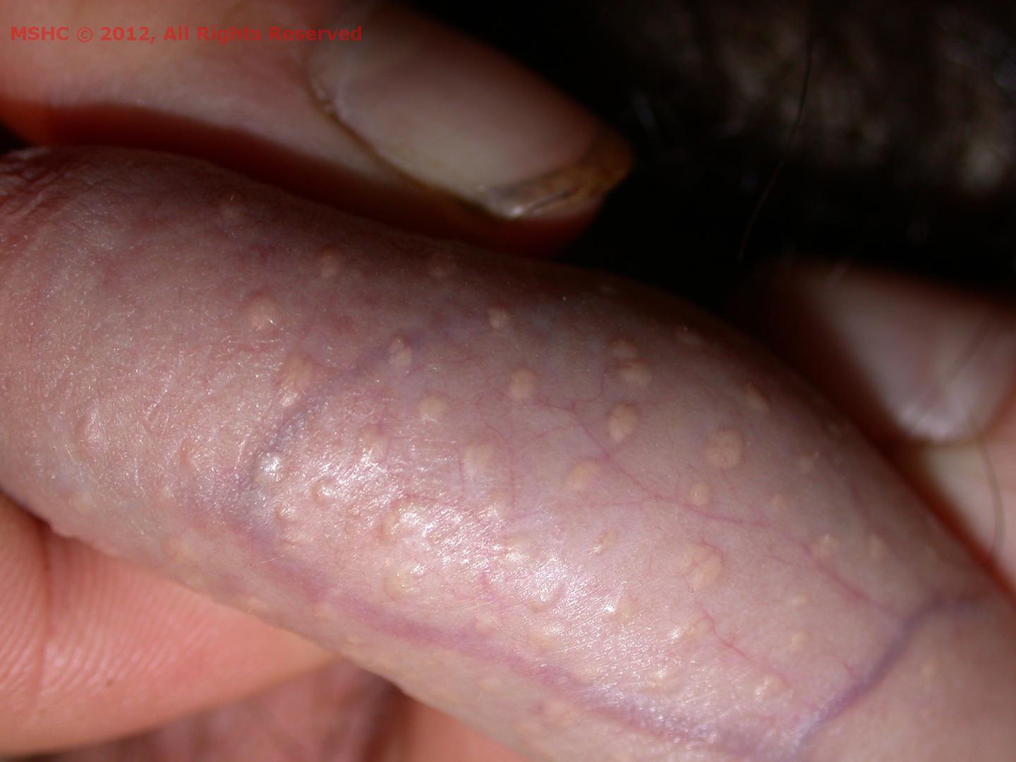 The vitiligo penis of Vitiligo on