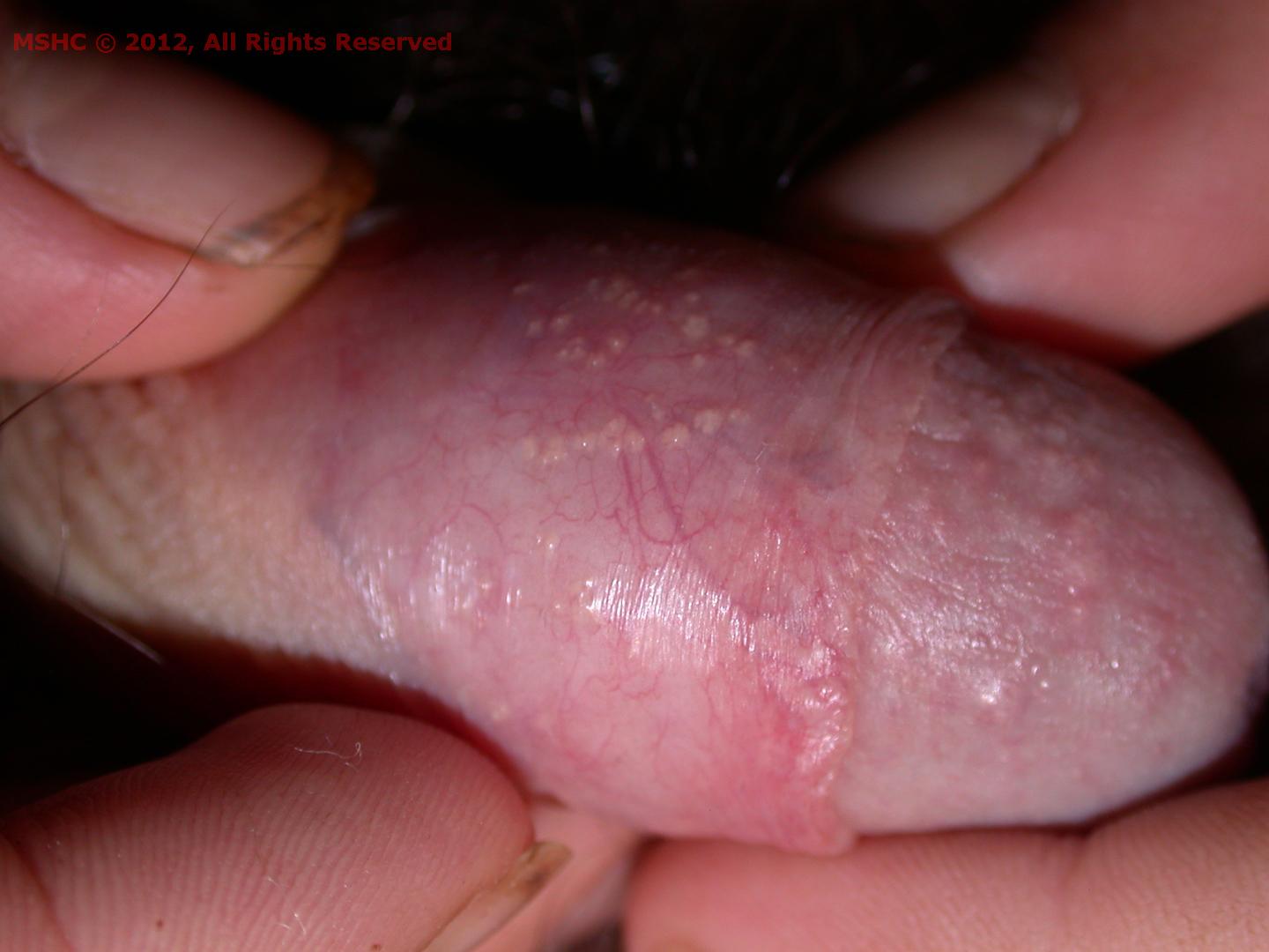 Penile papules on shaft