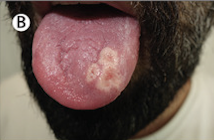 Three lesions the left side of the tongue