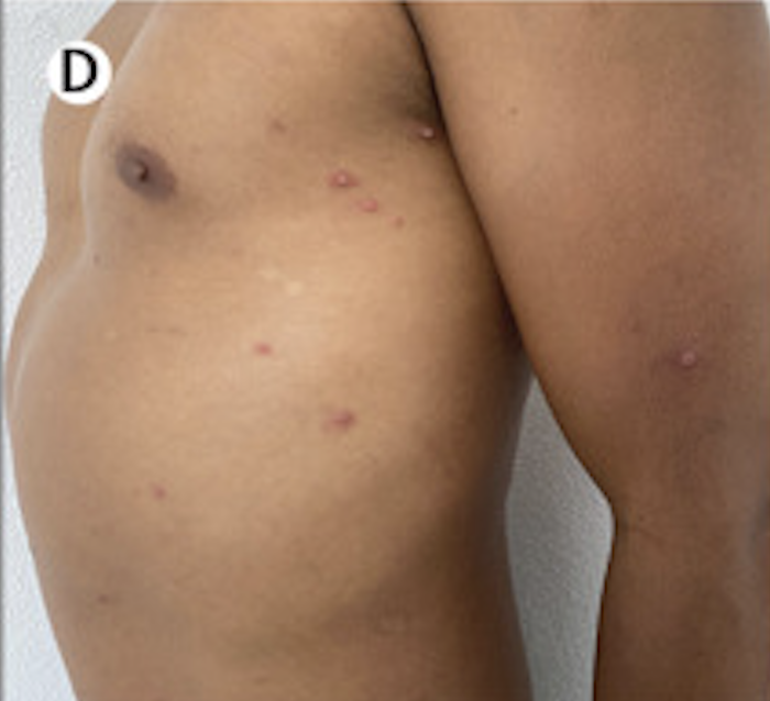 Inflamed MPX papules and pustules on chest and left arm