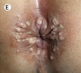 Pustules the anal and perianal skin.