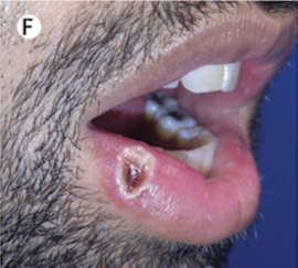 A MPX lesion with a crusted centre on the lower lip