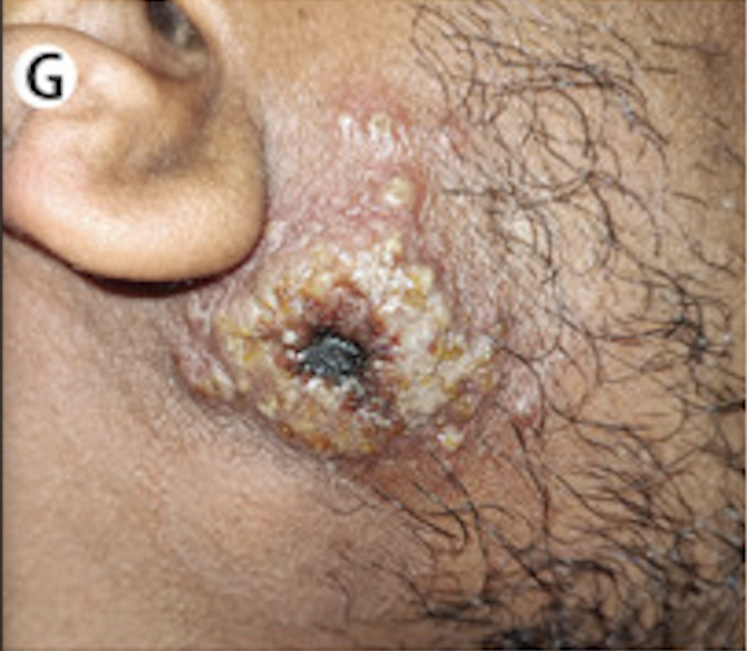 Large, crusted MPX lesion on the right cheek