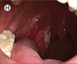 The right tonsil is reddened and enlarged and has an ulcer