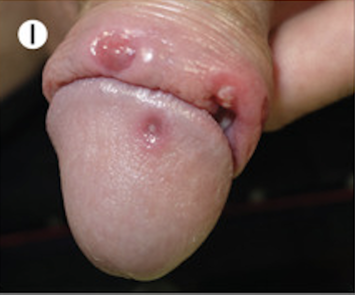 Penile glans and foreskin with lesions of varying sizes and stages of evolution, with swelling surrounding the larger ulcer.