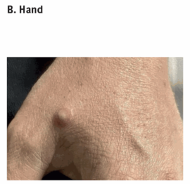 MPX lesions on hand on day 11 post symptom onset